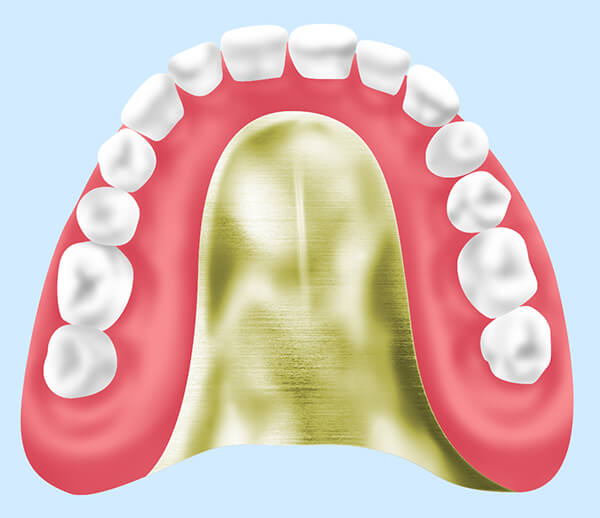 金属床義歯