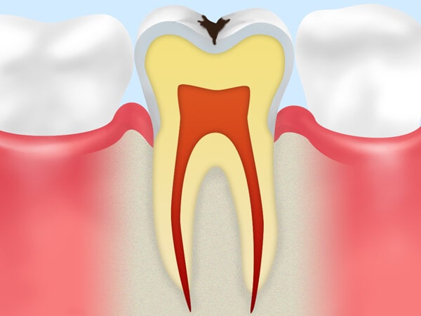 C1【エナメル質のむし歯】