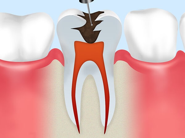 歯の神経・血管の除去