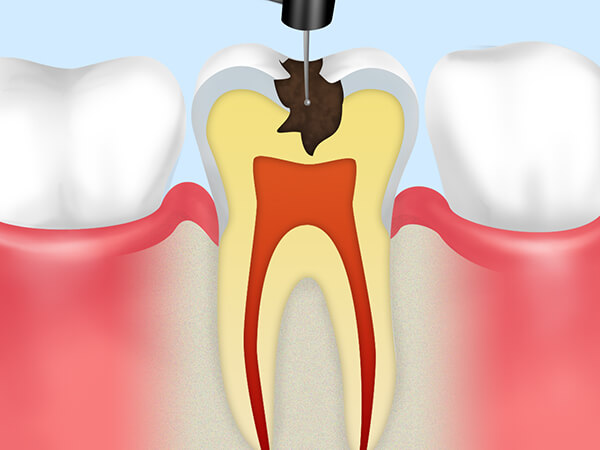 むし歯の除去