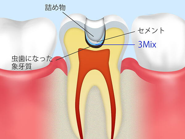 詰め物を詰める