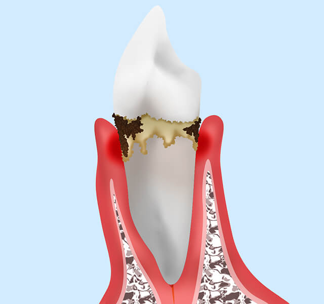 軽度歯周炎