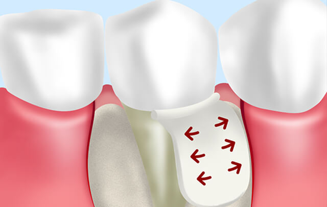 さまざまな歯周外科処置