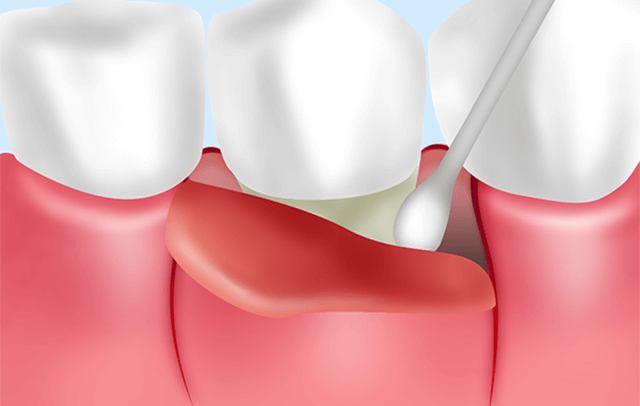 歯肉剥離そうは術