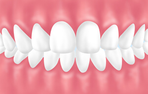 咬み合わせの治療